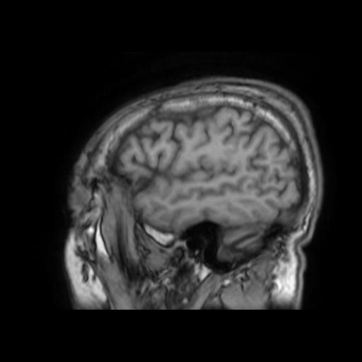 File:Cerebral venous thrombosis with secondary intracranial hypertension (Radiopaedia 89842-106957 Sagittal T1 25).jpg