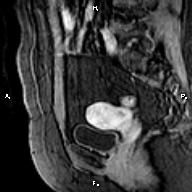 File:Cervical adenocarcinoma (Radiopaedia 65011-73985 E 10).jpg