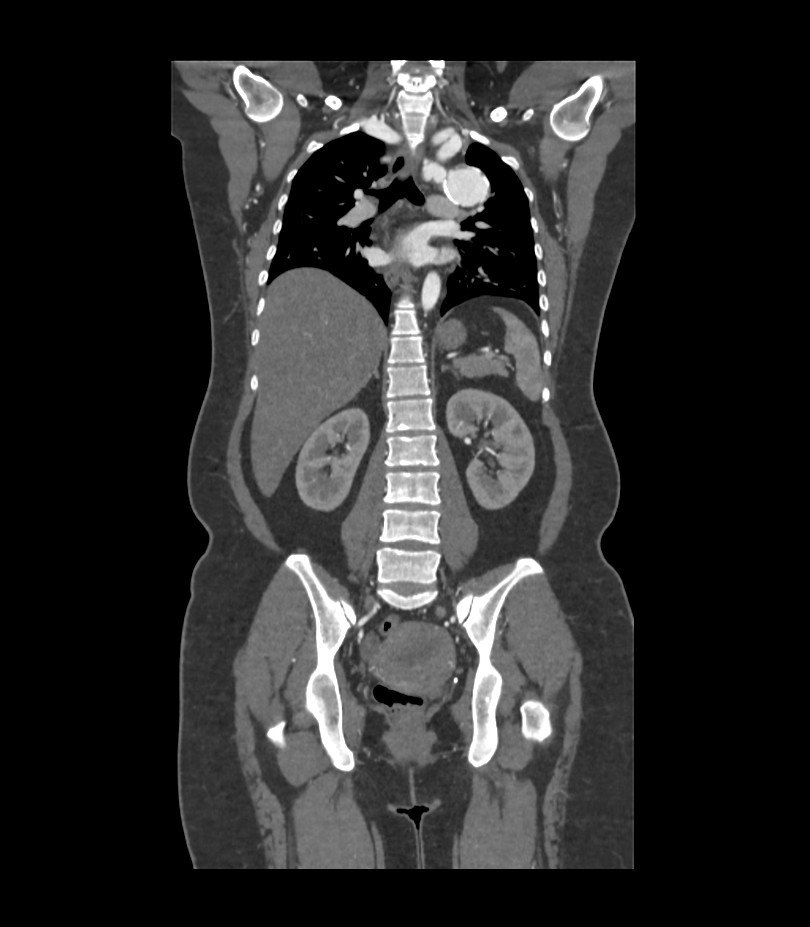 Cervical aortic arch with coarctation and aneurysms (Radiopaedia 44035-47552 C 18).jpg