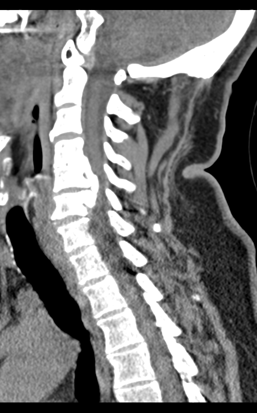 Cervical canal stenosis - OPLL and osteophytes (Radiopaedia 47329-51910 B 44).png
