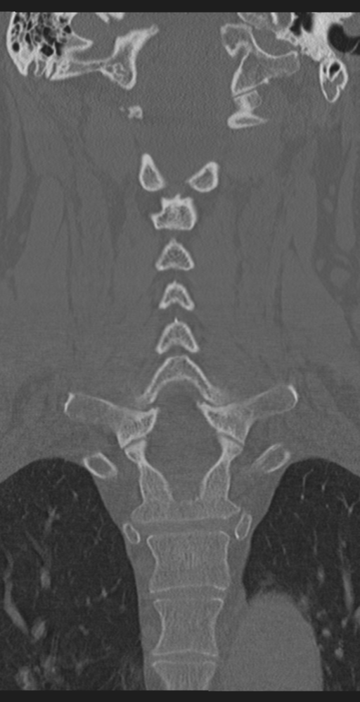 Cervical canal stenosis due to ossification of the posterior longitudinal ligament (Radiopaedia 47260-51823 Coronal bone window 35).png