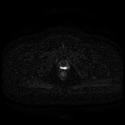 Cervical carcinoma (Radiopaedia 85405-101028 Axial DWI 23).jpg