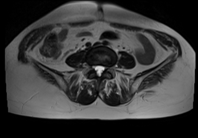 File:Cervical carcinoma (Radiopaedia 88312-104943 Sagittal T1 1).jpg