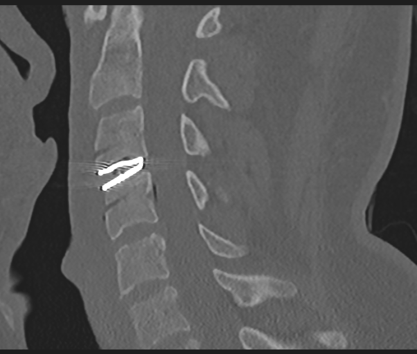 File:Cervical disc replacement (Radiopaedia 44025-47541 Sagittal bone window 41).png