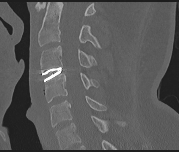 File:Cervical disc replacement (Radiopaedia 44025-47541 Sagittal bone window 42).png
