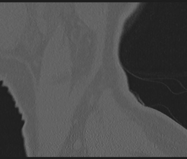 Cervical disc replacement (Radiopaedia 44025-47541 Sagittal bone window 80).png