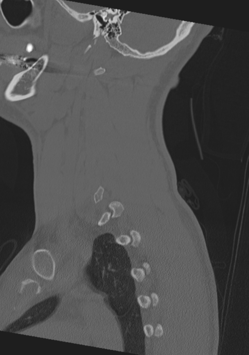 Cervical intercalary bone (Radiopaedia 35211-36748 Sagittal bone window 16).png
