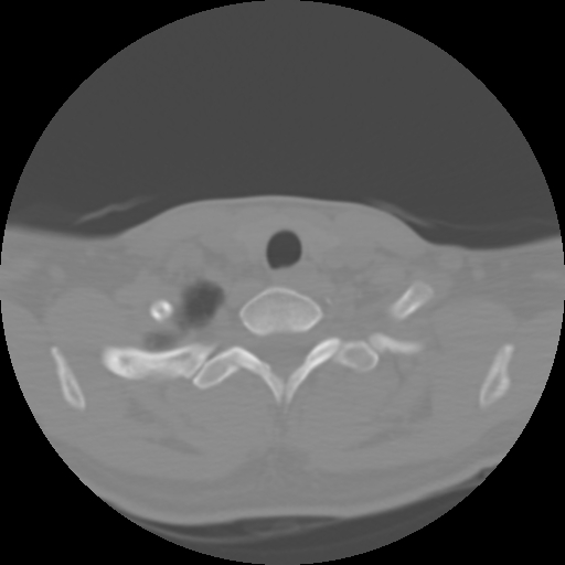 Cervical rib (Radiopaedia 71110-81363 Axial non-contrast 46).jpg