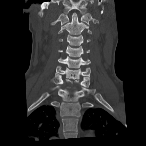 Cervical schwannoma (Radiopaedia 57979-64974 Coronal bone window 29).png