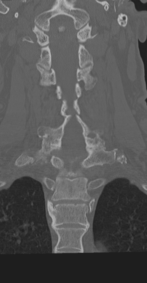 Cervical spine fracture in the setting of ankylosis (Radiopaedia 37038-38715 Coronal bone window 39).png