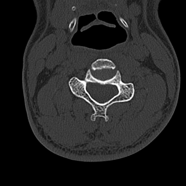 Cervical spondylodiscitis (Radiopaedia 28057-29489 Axial bone window 38).jpg