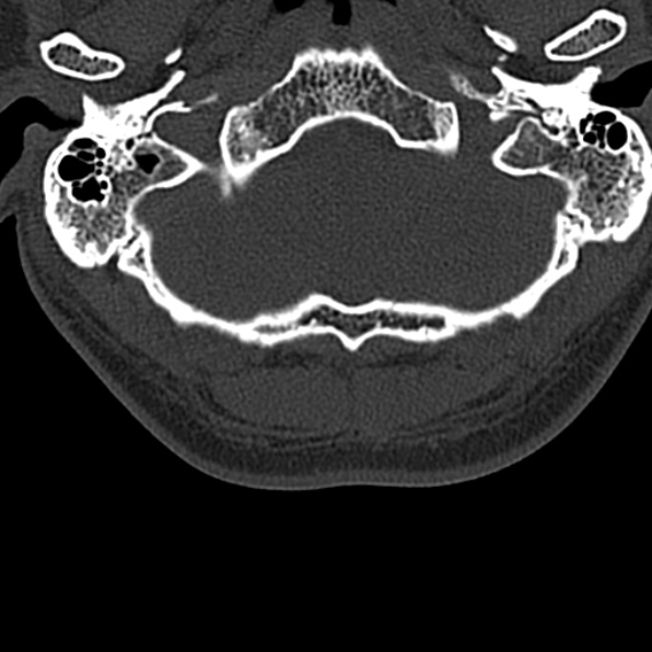 Cervical spondylodiscitis (Radiopaedia 28057-29489 Axial bone window 9).jpg