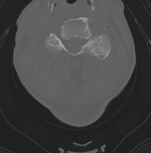 File:Cervical spondylolysis (Radiopaedia 49616-54811 Axial bone window 30).png