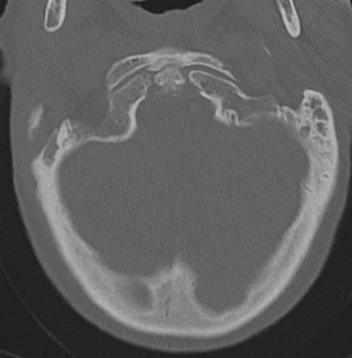 File:Cervical spondylolysis (Radiopaedia 49616-54811 Axial bone window 9).png