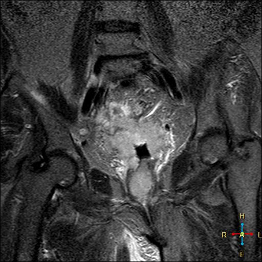 File:Cervical stump squamous cell carcinoma (Radiopaedia 48049-52858 G 6).jpg