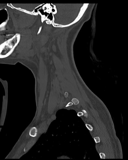 Cervical tuberculous spondylitis (Radiopaedia 39149-41365 Sagittal bone window 13).png