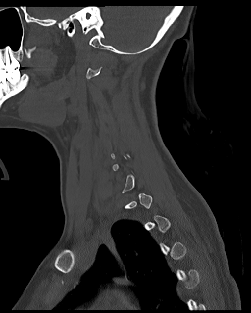 Cervical tuberculous spondylitis (Radiopaedia 39149-41365 Sagittal bone window 18).png