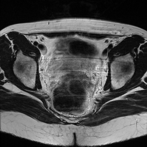 File:Cesarian section scar endometriosis (Radiopaedia 66520-75799 Axial T2 14).jpg