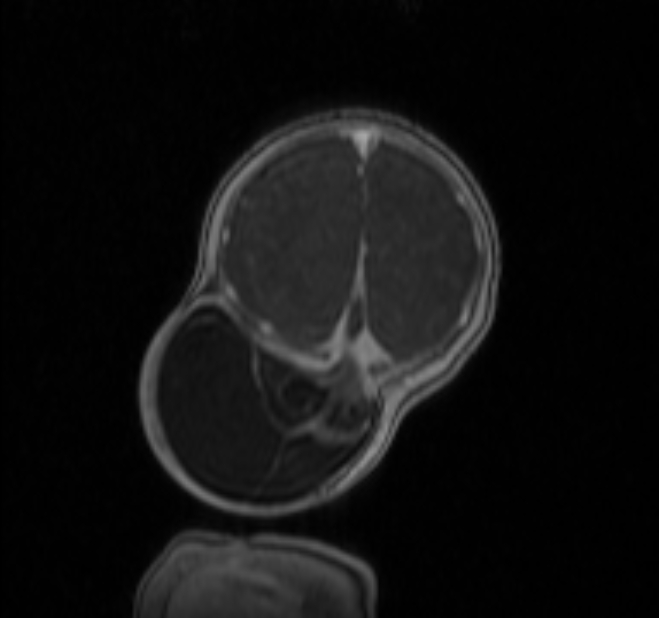 Chiari III malformation with occipital encephalocele (Radiopaedia 79446-92559 Coronal T1 C+ mpr 45).jpg