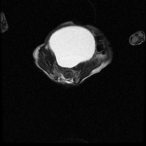 File:Chiari II malformation with spinal meningomyelocele (Radiopaedia 23550-23652 Axial T2 16).jpg