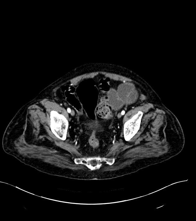 Cholangiocarcinoma with cerebral metastases (Radiopaedia 83519-98629 B 108).jpg