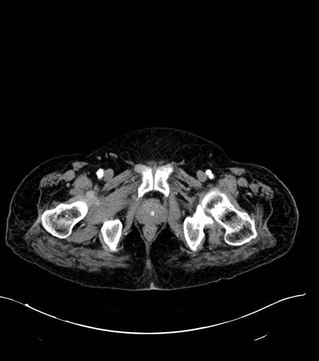 Cholangiocarcinoma with cerebral metastases (Radiopaedia 83519-98629 B 127).jpg