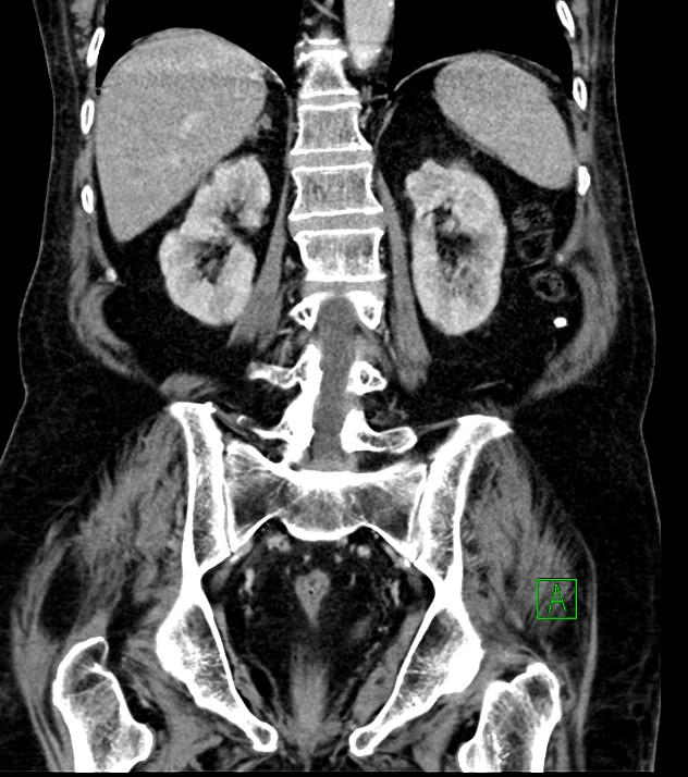 Cholangiocarcinoma with cerebral metastases (Radiopaedia 83519-98629 G 57).jpg