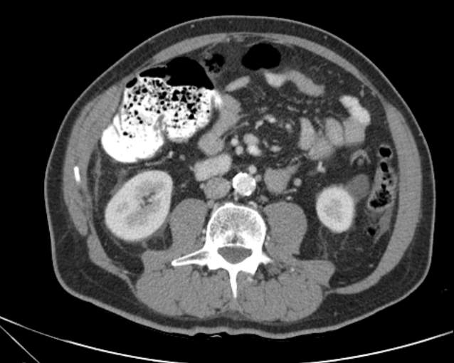 Cholecystitis - perforated gallbladder (Radiopaedia 57038-63916 A 45).jpg