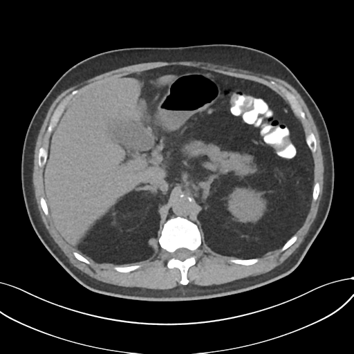 Cholecystitis with focal perforation and hepatic abscess (Radiopaedia 37189-38945 Axial non-contrast 24).png