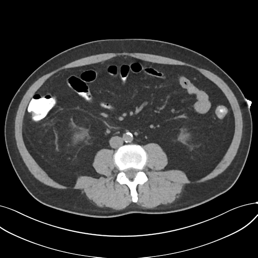 File:Cholecystitis with focal perforation and hepatic abscess (Radiopaedia 37189-38945 Axial non-contrast 47).png