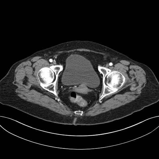 Cholecystoduodenal fistula due to calculous cholecystitis with gallstone migration (Radiopaedia 86875-103077 A 69).jpg