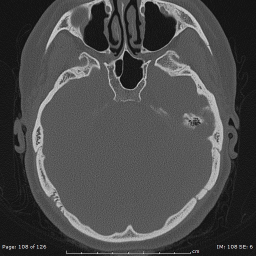 Cholesteatoma - external auditory canal (Radiopaedia 88452-105096 Axial bone window 71).jpg