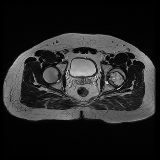 File:Chondroblastoma (Radiopaedia 12264-12564 Axial T2 6).jpg