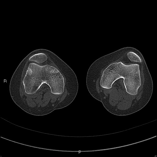 Chondroblastoma (Radiopaedia 62721-71030 Axial bone window 11).jpg