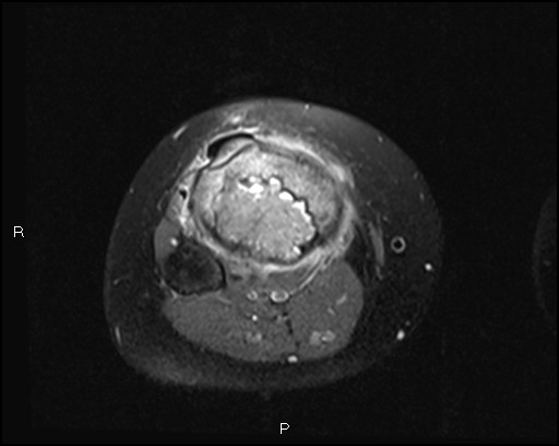 File:Chondroblastoma (Radiopaedia 62721-71031 Axial PD fat sat 26).jpg