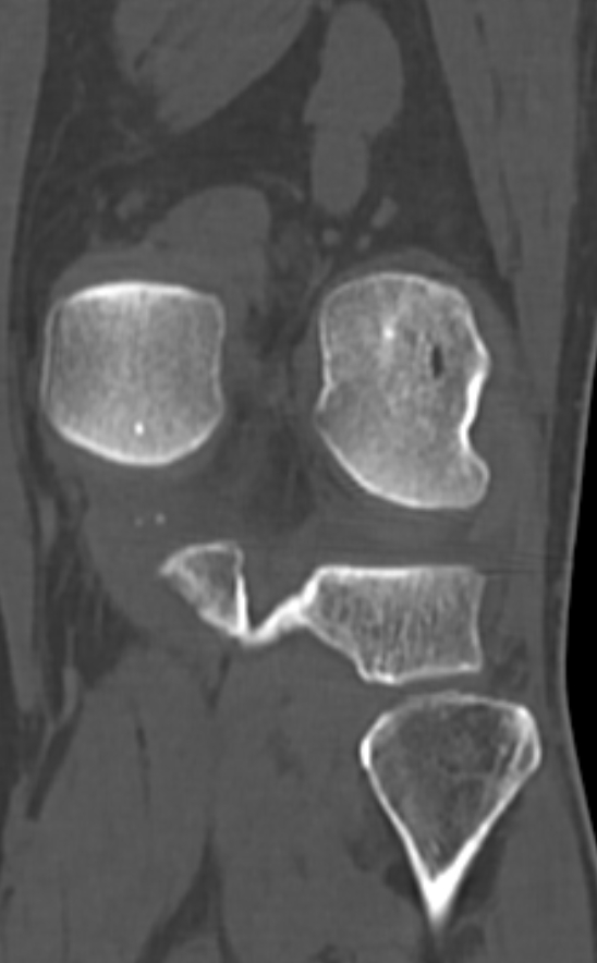 Chondrocalcinosis (Radiopaedia 82862-97173 Coronal bone window 60).jpg