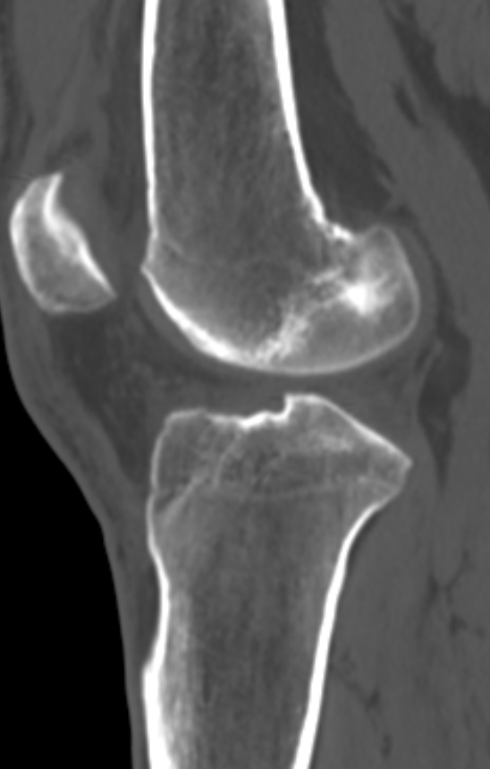 Chondrocalcinosis (Radiopaedia 82862-97173 Sagittal bone window 36).jpg