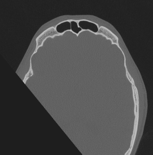 Chondrosarcoma (clivus) (Radiopaedia 46895-51425 Axial bone window 5).png