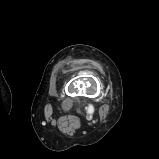 File:Chondrosarcoma - femur (Radiopaedia 64187-72954 Axial with contrast 29).jpg