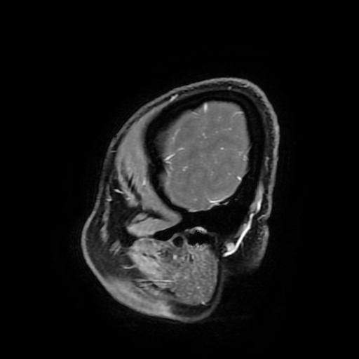 Chordoid glioma of third ventricle (Radiopaedia 91612-109340 F 184).jpg
