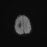 File:Choroid plexus papilloma (Radiopaedia 84612-100019 Axial DWI 46).jpg