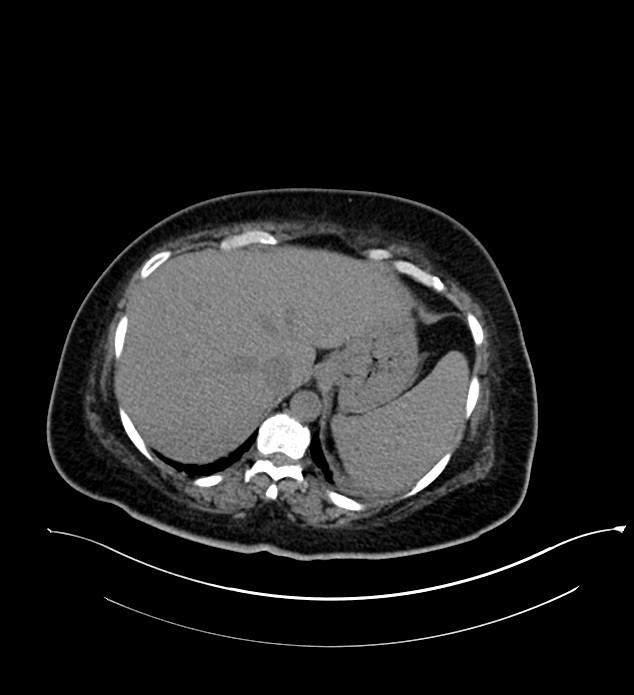 Chromophobe renal cell carcinoma (Radiopaedia 84239-99519 Axial non-contrast 36).jpg