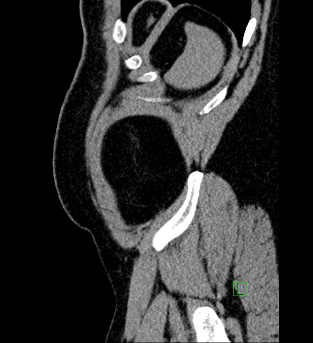 Chromophobe renal cell carcinoma (Radiopaedia 84286-99573 C 10).jpg