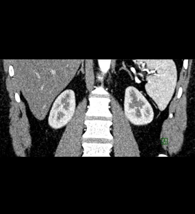 Chromophobe renal cell carcinoma (Radiopaedia 84286-99573 E 62).jpg