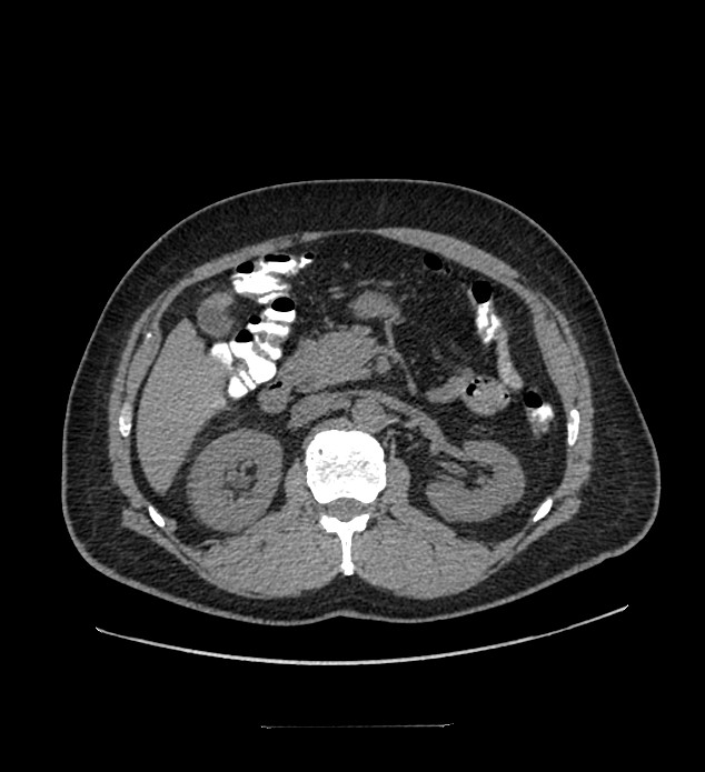 Chromophobe renal cell carcinoma (Radiopaedia 84337-99644 Axial non-contrast 37).jpg
