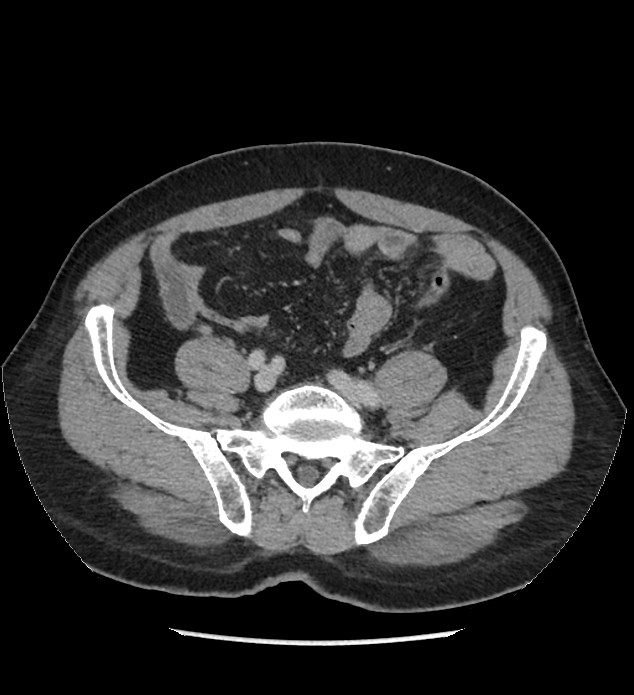 Chromophobe renal cell carcinoma (Radiopaedia 86879-103083 C 110).jpg