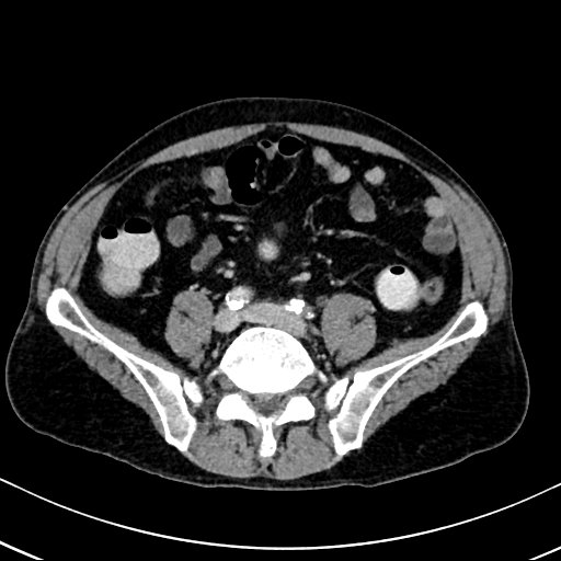 Chronic appendicitis complicated by appendicular abscess, pylephlebitis and liver abscess (Radiopaedia 54483-60700 B 101).jpg