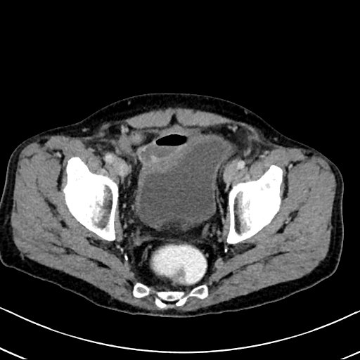 Chronic appendicitis complicated by appendicular abscess, pylephlebitis and liver abscess (Radiopaedia 54483-60700 B 130).jpg