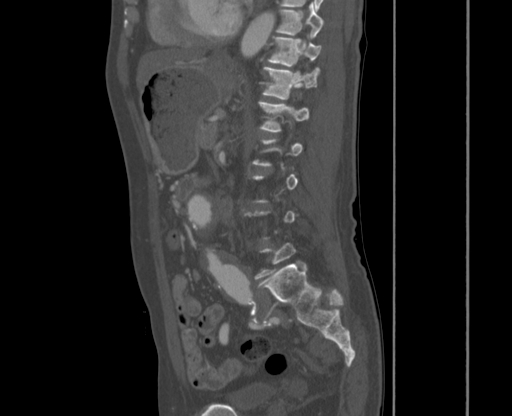 File:Chronic contained rupture of abdominal aortic aneurysm with extensive erosion of the vertebral bodies (Radiopaedia 55450-61901 Sagittal bone window 38).jpg