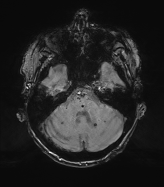 Chronic hypertensive encephalopathy (Radiopaedia 72844-83495 Axial SWI magnitude 21).png